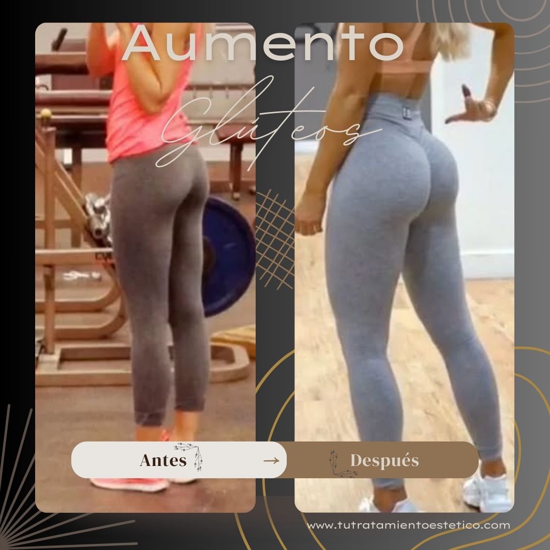 Aumento de Glúteos