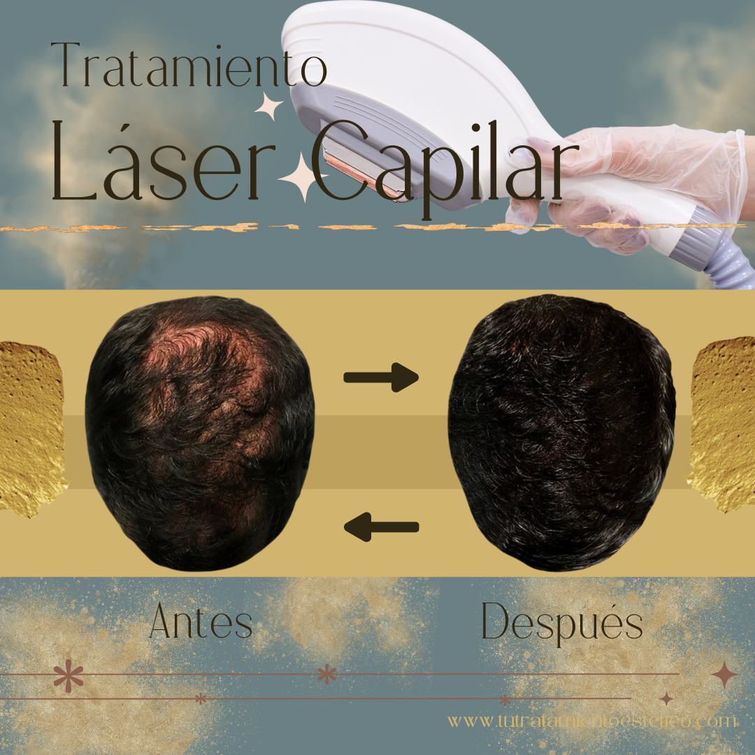 Tratamiento capilar con láser de baja frecuencia
