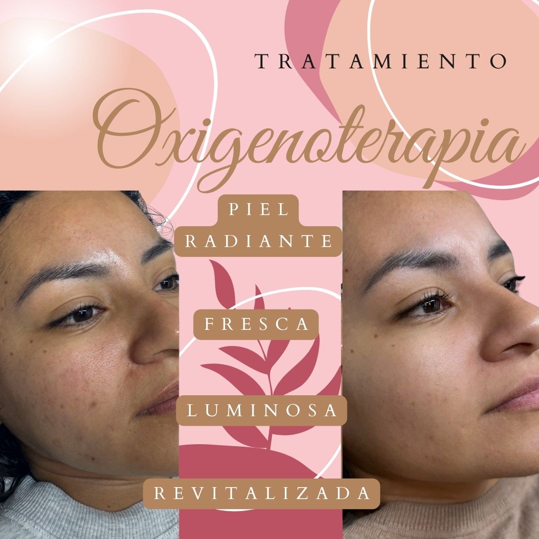 Oxigenoterapia Facial