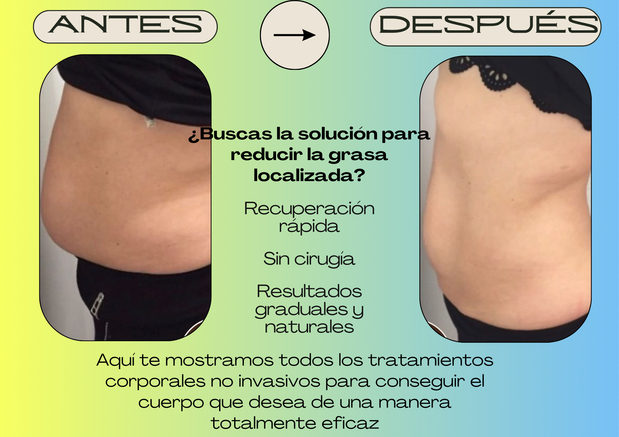 Reducción de Grasa Localizada sin Cirugía