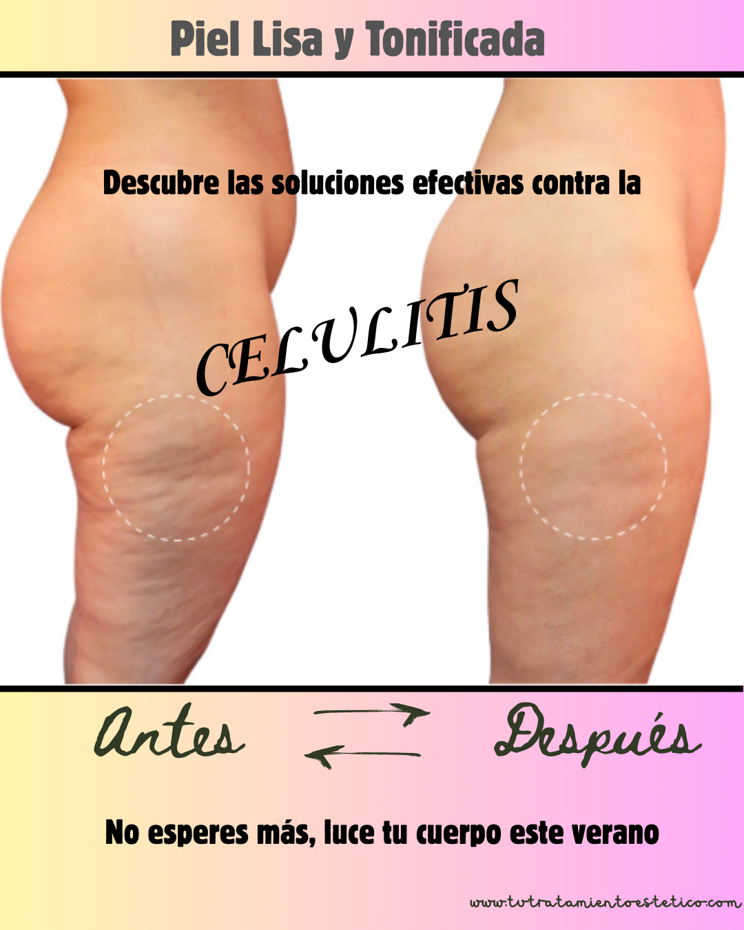 Tratamientos para la Celulitis
