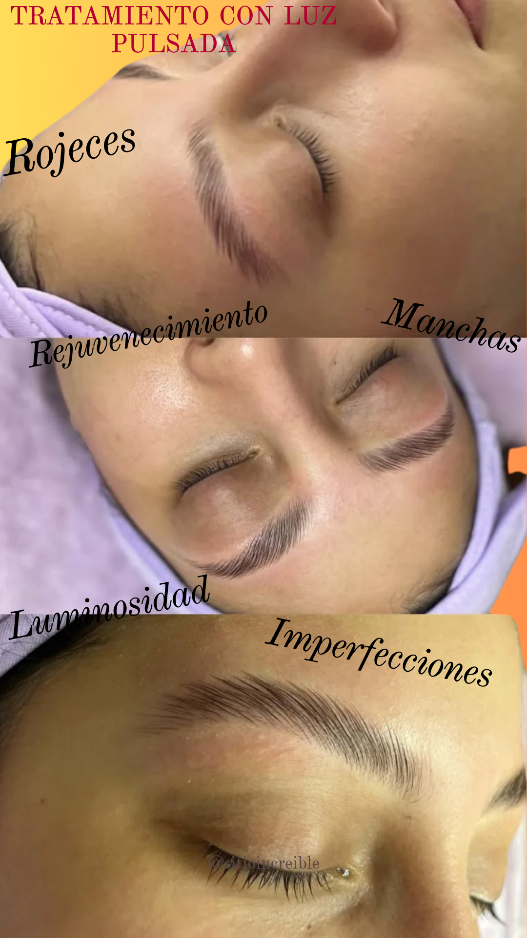 Tratamiento facial con Luz Pulsada Intensa
